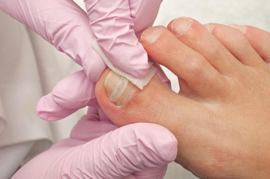 Ingrown Toe Nail services in Miami